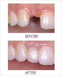 THỰC HIỆN PHỤC HÌNH TRỰC TIẾP TRÊN IMPLANT