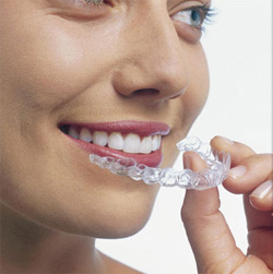 Phương pháp chỉnh hình răng mới Invisalign teen