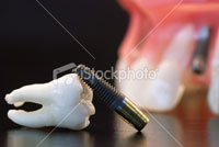 CÁC YẾU TỐ QUYẾT ĐỊNH ĐỐI VỚI CHỊU LỰC IMPLANT TỨC THÌ
