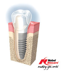 HỆ THỐNG IMPLANT NOBEL BIOCARE TẠI AVA