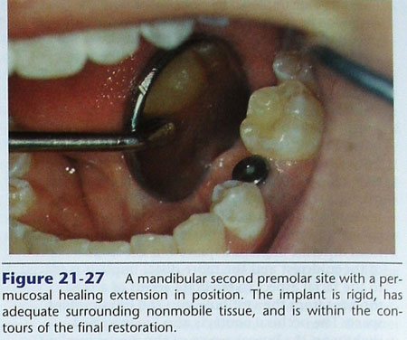 phuc-hinh-implant