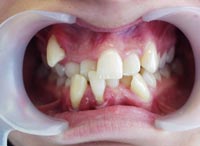 Mối liên quan giữa lệch lạc khớp cắn và dịch vụ Niềng răng?