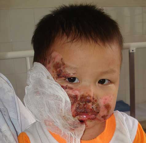 SƠ CỨU MỘT SỐ TAI NẠN THƯỜNG GẶP Ở TRẺ EM