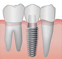 Cấy Ghép Implant Thay Thế Nhiều Răng