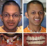 Khi nào nên cấy ghép implant?