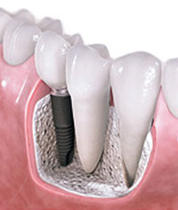 Cấy ghép răng (Implant)