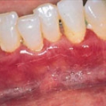 Bệnh nướu do yếu tố toàn thân
