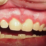 Viêm nướu do virus herpes