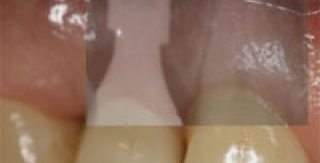 LỊCH SỬ PHÁT TRIỂN IMPLANT TỨC THÌ