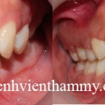 Chỉnh hình răng thẩm mỹ điều trị răng dư kẽ giữa với mắc cài kim loại