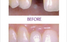 THỰC HIỆN PHỤC HÌNH TRỰC TIẾP TRÊN IMPLANT
