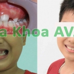 Bảng giá niềng răng mới nhất tại nha khoa AVA