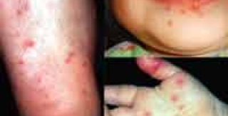 Kết quả của một số nghiên cứu về bệnh tay chân miệng 