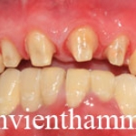 Răng sứ Emax Zircad - Ivoclar Vivadent - Thụy Sỹ 20