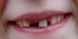 Chăm sóc răng miệng khẩn cấp cho bé