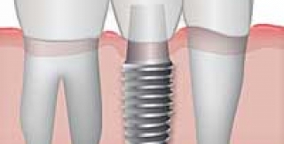 Cấy Ghép Implant Thay Thế Nhiều Răng 