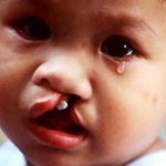 Sứt môi và khe hở hàm ếch : (Cleft lip and cleft palate)