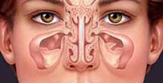 Viêm xoang hàm do bệnh răng