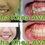 Niềng răng mọc chen chúc ở trẻ em