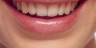 Các phương pháp Tẩy trắng răng