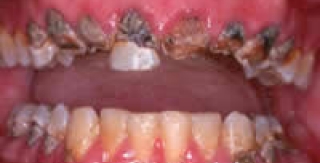 Mục đích của vệ sinh răng miệng