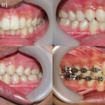 Chỉnh hình răng thẩm mỹ điều trị răng cắn chìa hô với mắc cài kim loại