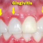 Viêm nướu do vệ sinh răng miệng chưa tốt