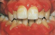 QUÁ TRIỂN NƯỚU DO PHENYTOIN