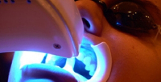 Tẩy trắng răng là gì ?