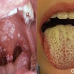 NHIỄM NẤM CANDIDA 