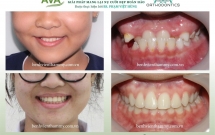 Niềng răng móm (khớp cắn ngược) ở trẻ em và người lớn