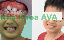 Bảng giá niềng răng mới nhất tại nha khoa AVA