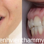Chỉnh hình răng thẩm mỹ điều trị răng thưa + Răng nanh mọc sai chỗ