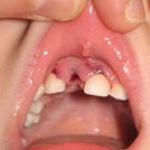 Xử trí khi răng trẻ bị bật khỏi ổ răng