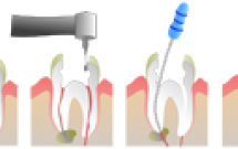 Chữa tủy răng, phương pháp nội nha là gì? (Enodontics, root canal treatment) 