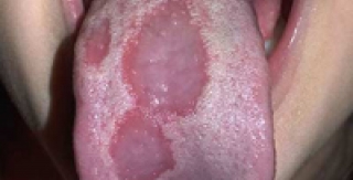 Viêm lưỡi bản đồ 
