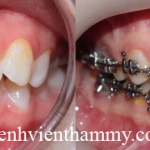 Chỉnh hình răng thẩm mỹ điều trị răng hô với mắc cài kim loại 2