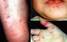 Bệnh tay chân miệng là gì? 