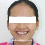 Ưu điểm Chỉnh răng không nhổ răng