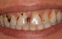 Chế độ ăn gây sâu răng