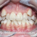 Chỉnh hình răng thẩm mỹ điều trị răng khểnh với mắc cài kim loại