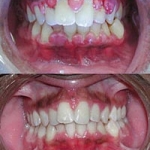 Các yếu tố toàn thân hỗ trợ làm trầm trọng bệnh viêm nướu