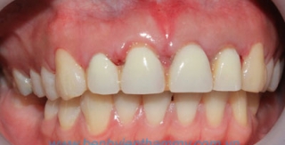 Răng sứ Emax Zircad - Ivoclar Vivadent 8