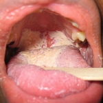 Bệnh do vi nấm ở vùng hàm mặt 