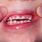 Tật nghiến răng ở trẻ em – Phần 1