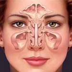 Viêm xoang hàm do răng (Sinusitis)