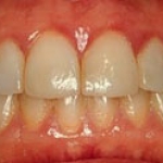Viêm nướu do mảng bám vi khuẩn