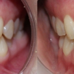 Chỉnh hình răng thẩm mỹ điều trị răng chen chúc với mắc cài kim loại 02