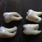 Tại Sao Cần Phải Nhổ Răng Khôn?