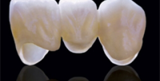 Hệ thống sứ Cercon thông minh 